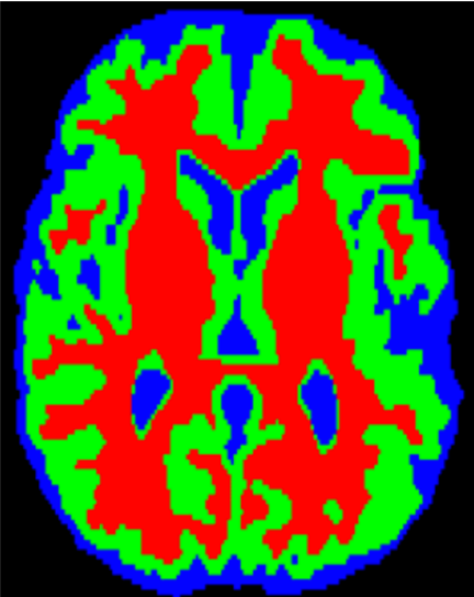 Medical Image Segmentation